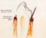 牙周病第一階段：牙齦紅腫
