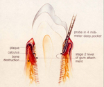 牙周病第二階段：牙齦剝離形成囊袋