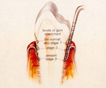 牙周病第三階段：囊袋化膿、齒槽骨流失
