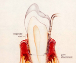 牙周病第四階段：牙根大幅暴露、牙齒動搖