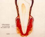牙周病第五階段：牙根周遭組織毀損