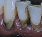 牙周病臨床治療實例