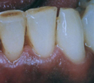 牙周病臨床治療實例